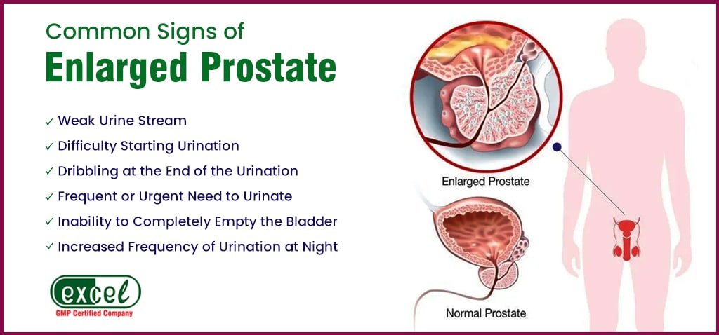 Common Signs of Enlarged Prostate