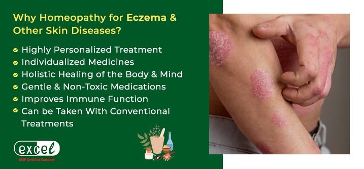 benefits of homeopatic medicine for eczema
