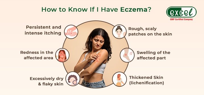 symptoms of Eczema